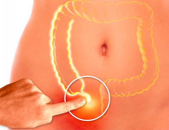 appendicitis3