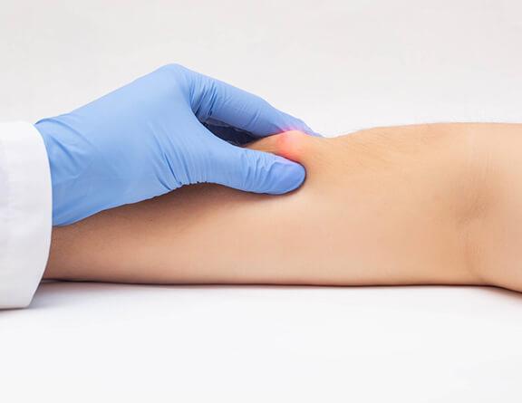 lipoma